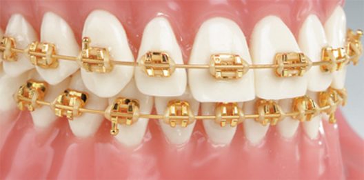 Gold Braces Only In Beverly Hills